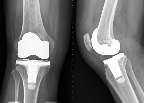 Knee joint replacement X-ray